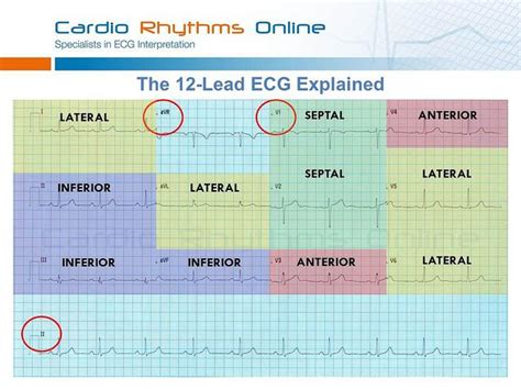 12 Lead Ecg Interpretation