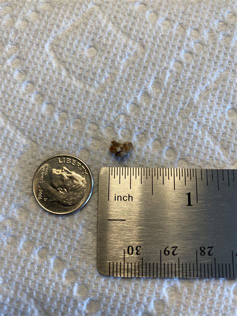 7Mm Kidney Stone