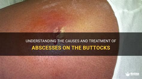 Abscess Inside Buttock
