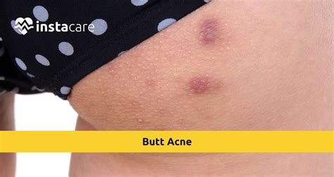 Acne On Butt