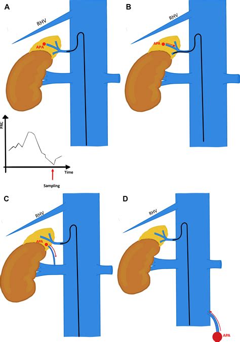 Adrenal Venous Sampling