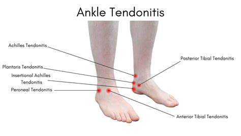 Ankle Tendon Pain