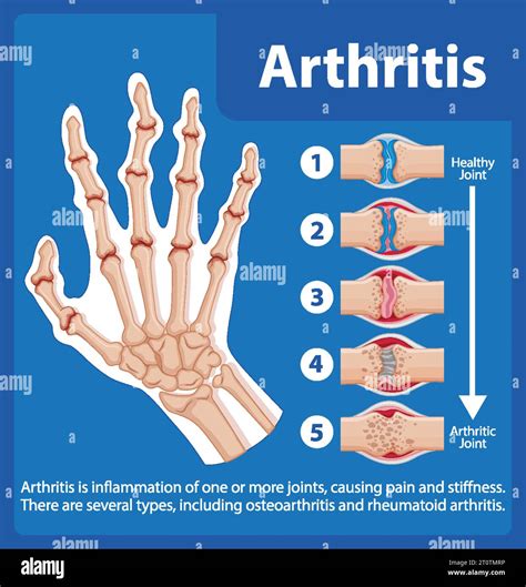 Arthritis In Hand