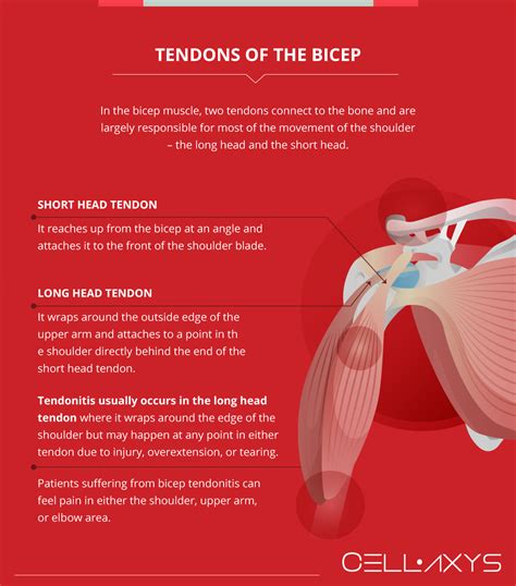 Bicep Tendonitis Treatment