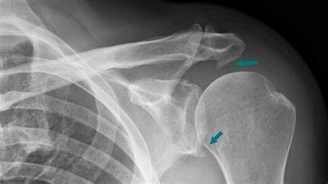 Bone Spur Shoulder
