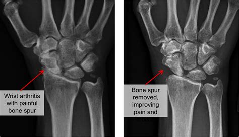 Bone Spur Wrist