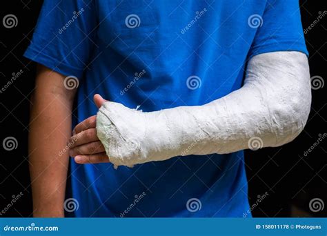 Broken Arm Cast