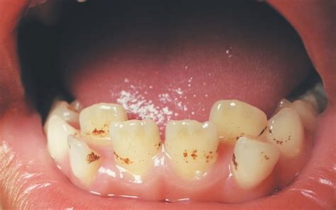 Brown Spot On Tooth