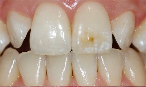 Brown Spots On The Teeth