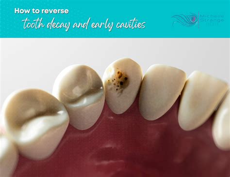 Can You Reverse Cavities