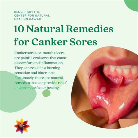 Canker Sore Treatment At Home