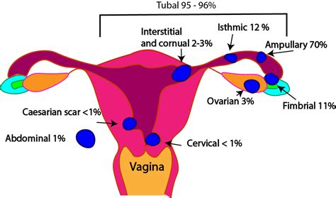 Cornual Ectopic Pregnancy