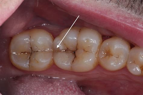 Crack In Tooth