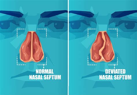 Cures For Deviated Septum