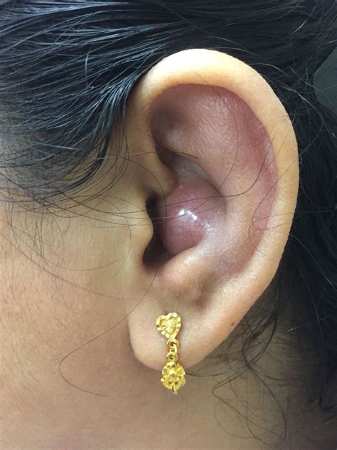 Cyst Inside Ear