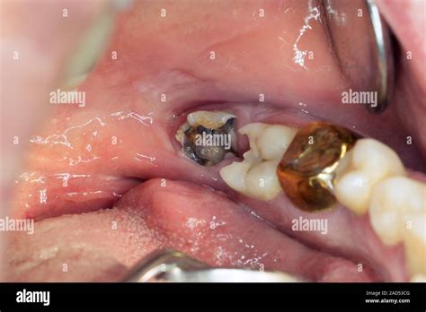 Decay In Wisdom Teeth