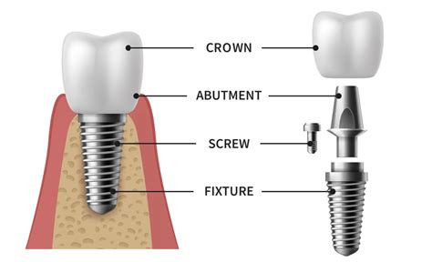 Dental Implant Parts