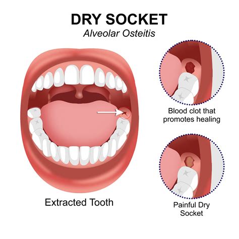 Dry Socket Medication