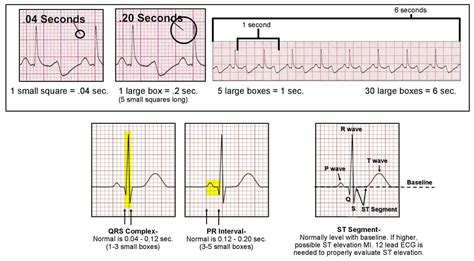 Ekg Interpretation