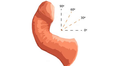 Enfermedad De Peyronie