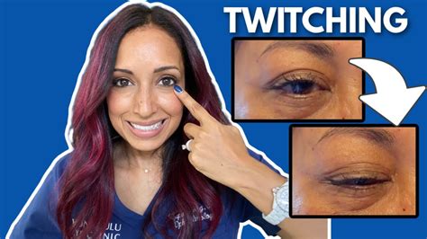 Eye Doctor For Eye Twitching