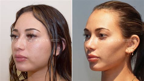 Face Fat Removal Surgery Ayer Ma
