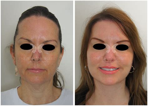 Face Grafting Surgery
