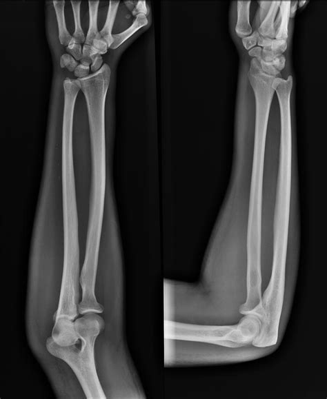 Forearm X Ray