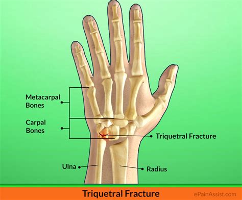 Fractured Triquetral Bone