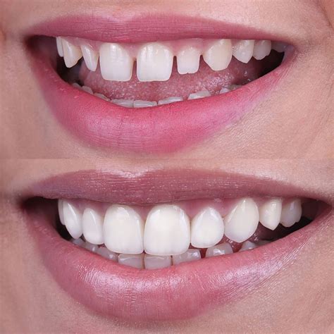 Front Teeth Veneers