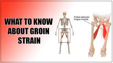 Groin Strain Recovery