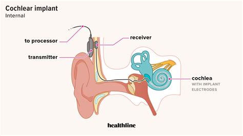 How Do Cochlear Implants Work