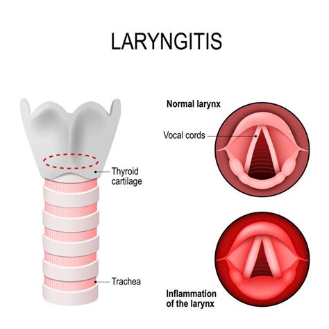 How Long Does Laryngitis Last
