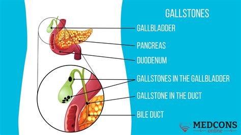 How To Get A Gallstone