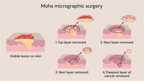 How To Prepare For Mohs Surgery On Face