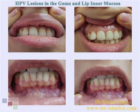 Hpv On Lips