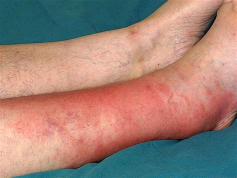 Is Cellulitis Spreadable
