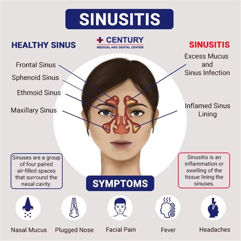 Is Sinusitis Contagious