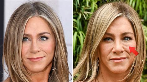Jennifer Aniston Surgery Face