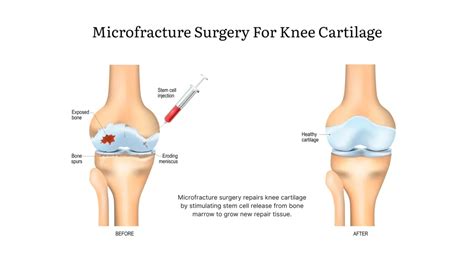 Knee Cartilage Surgery