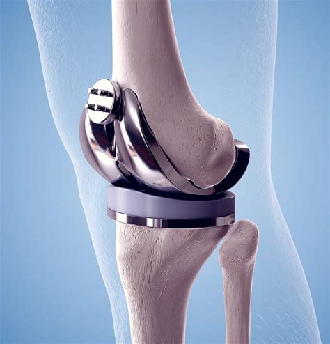 Knee Replacement Images