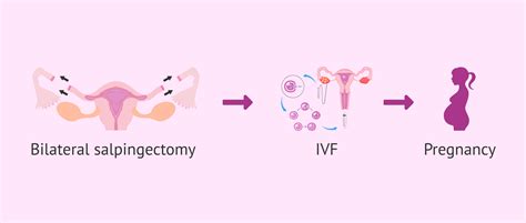 Laparoscopic Bilateral Salpingectomy