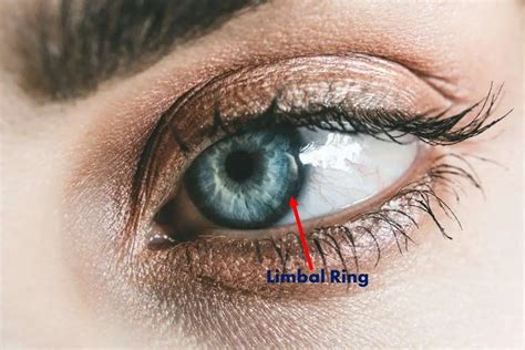 Limbal Ring