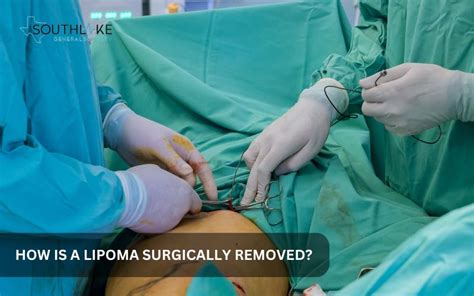 Lipoma Removal Surgery