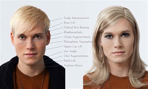 Male To Female Face Surgery