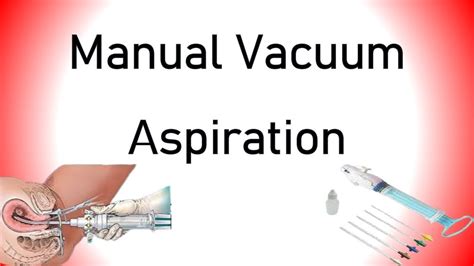 Manual Vacuum Aspiration