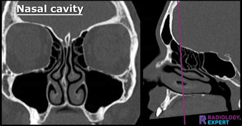 Nasal Ct Scan