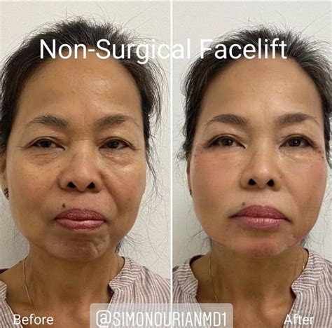 Non Surgical Facelift