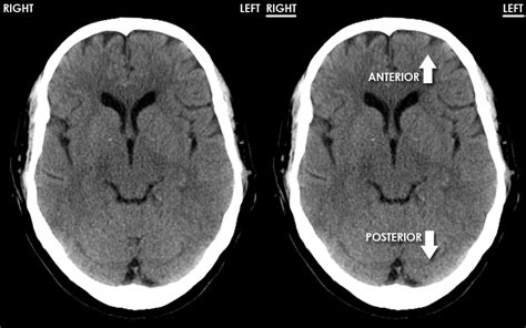 Normal Brain Ct