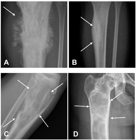 Osteosarcoma X Ray